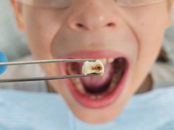 Best Emergency Tooth Extraction in Four Corners, MT